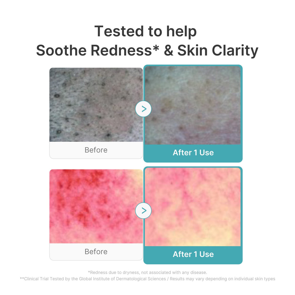 Azelaic Acid Capsule Foam Cleanser Y8