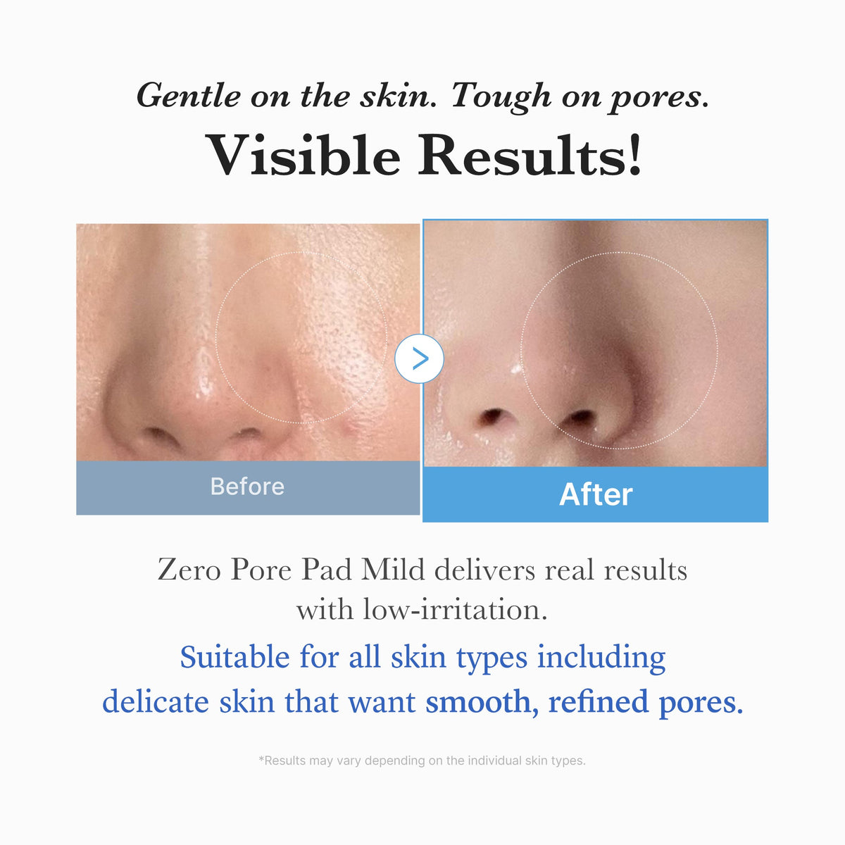 Zero Pore Madecassoside Pads (Mild) X6